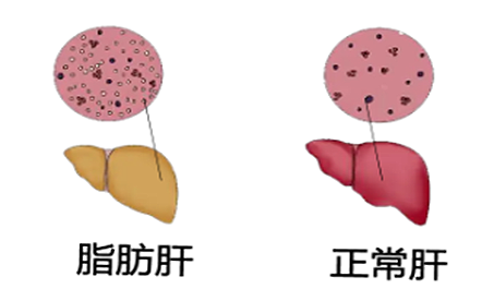 近三分之一人都患的脂肪肝，到底要不要管它？