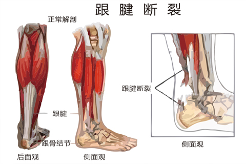 跟腱断裂