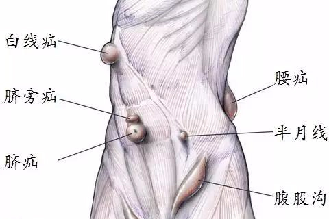 腹股沟疝健康宣教