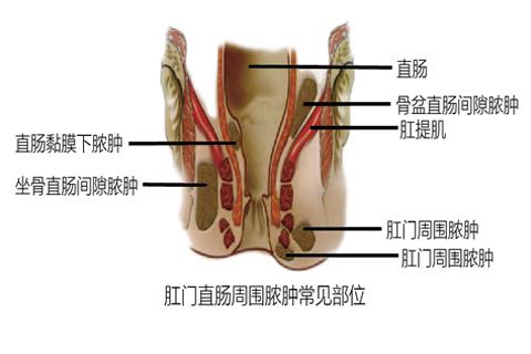 肛周脓肿